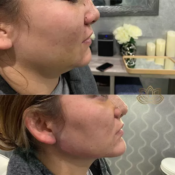 Chin Augmentation
