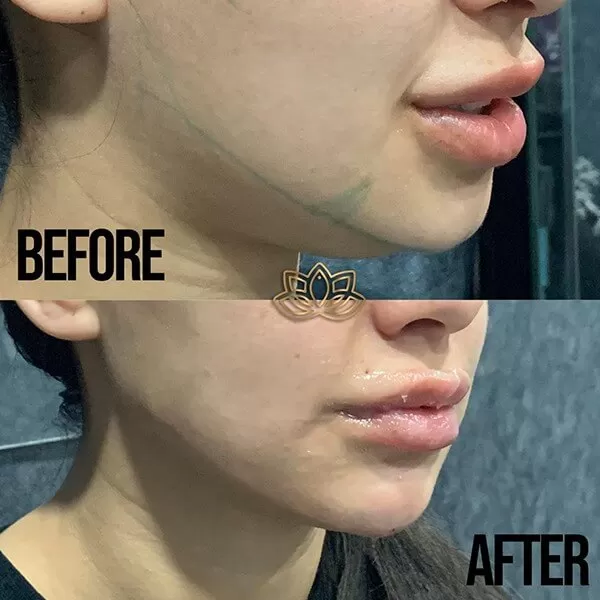 Jaw Contouring