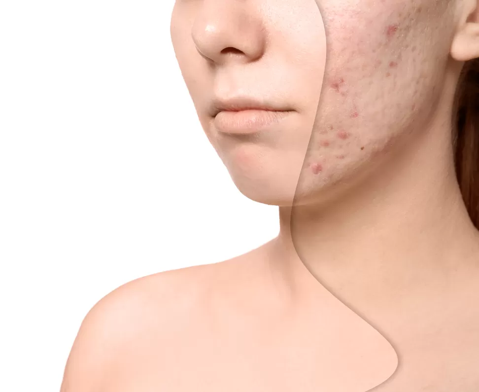 CO2 Fractional Laser