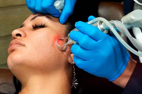 Laser tattoo removal treatment at Vive Med Spa