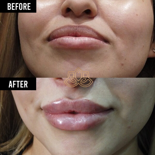 Dermal Fillers