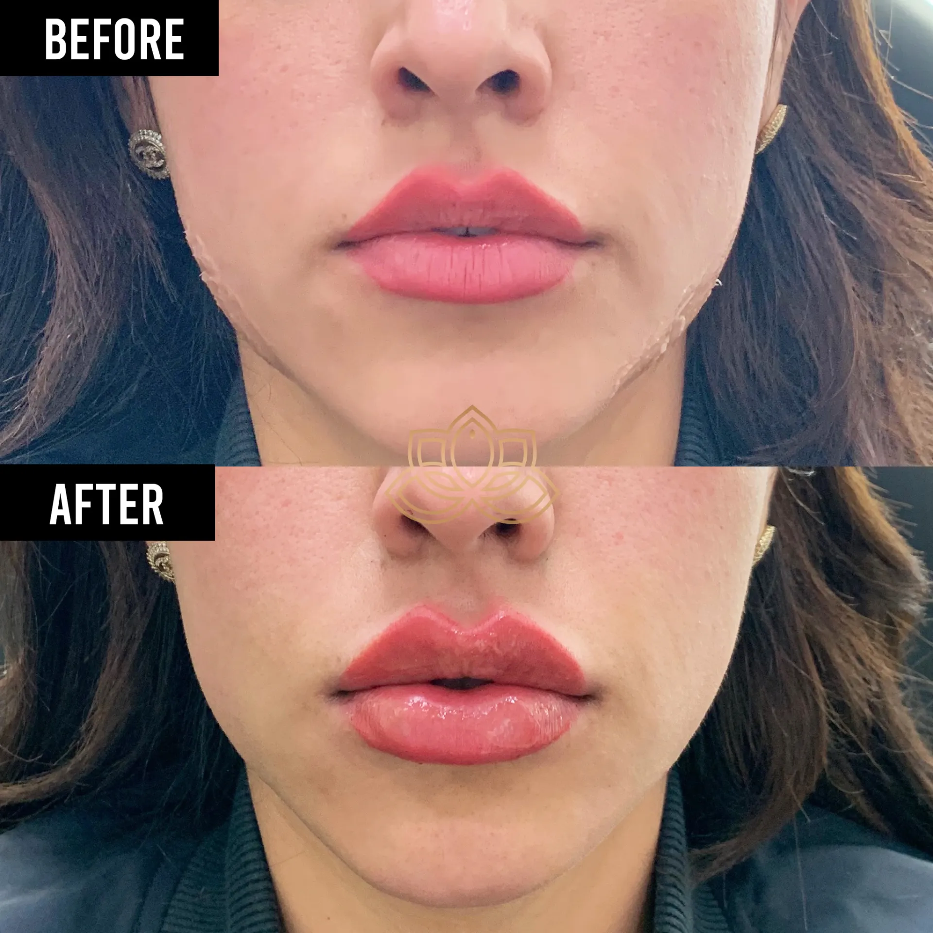 Hydrafacial