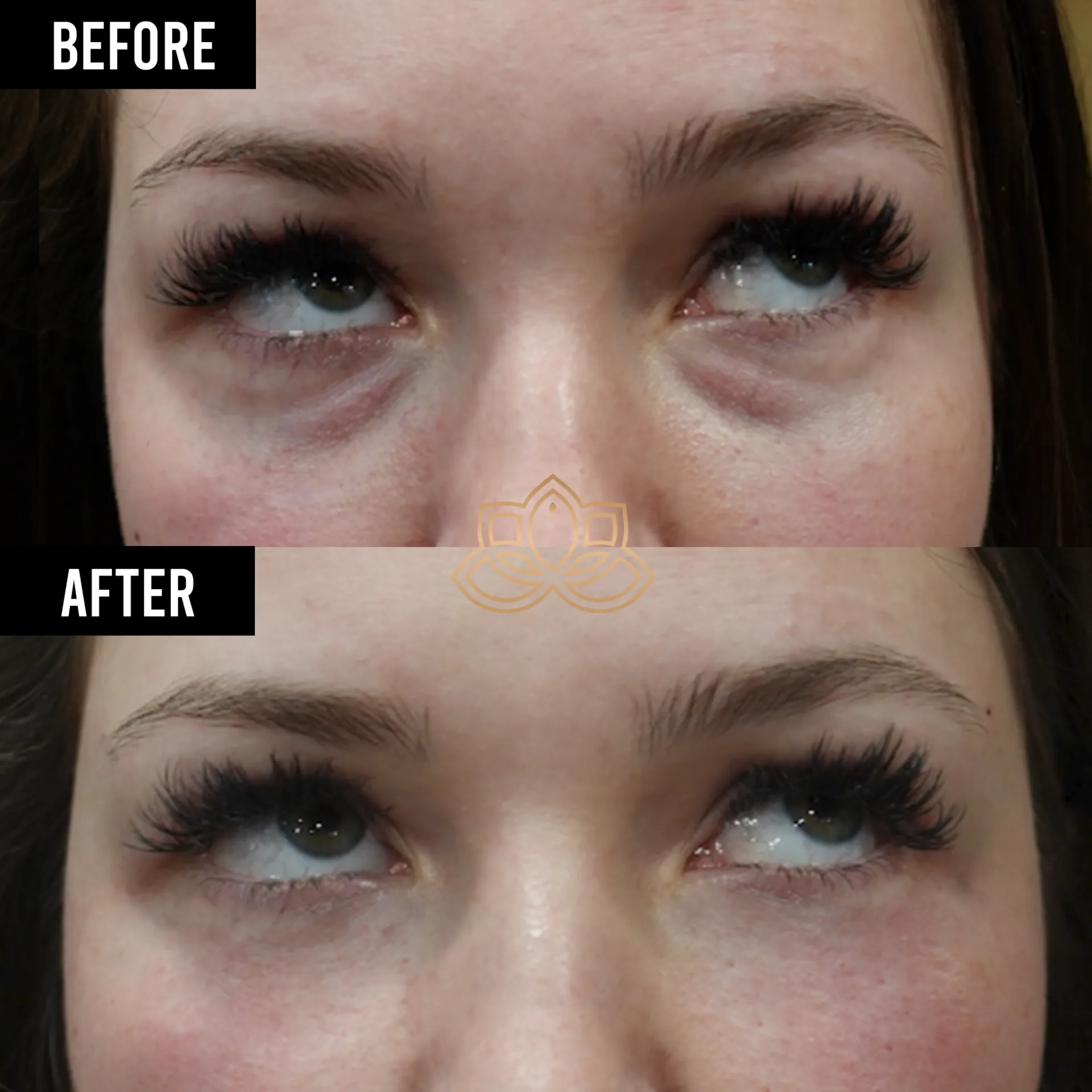 Botox