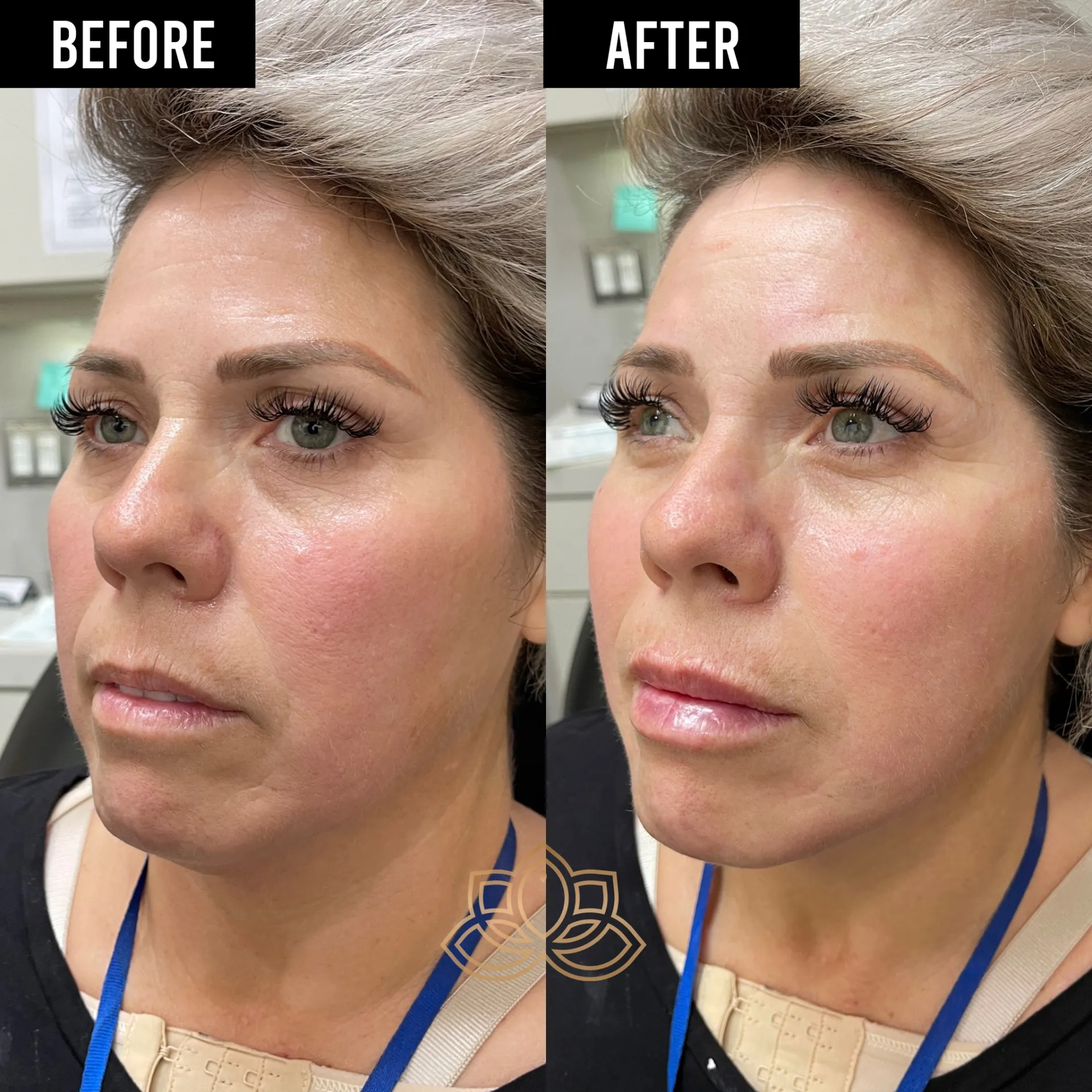 Foxy Eyes PDO thread treatment at Vive Medical Spa