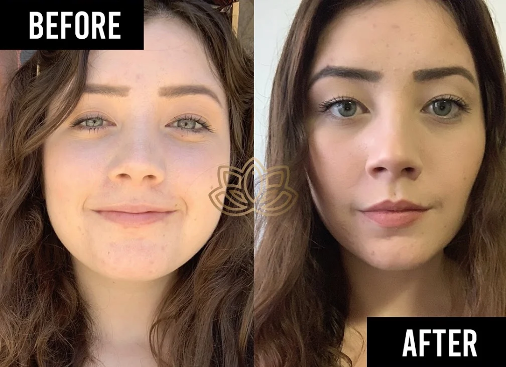 Before and after buccal fat removal - Vive Medical Spa Tijuana