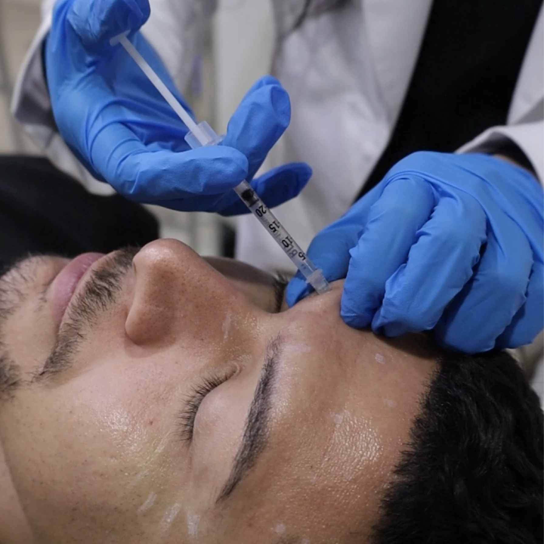 Sofwave SUPERB ultrasound technology delivering collagen stimulation