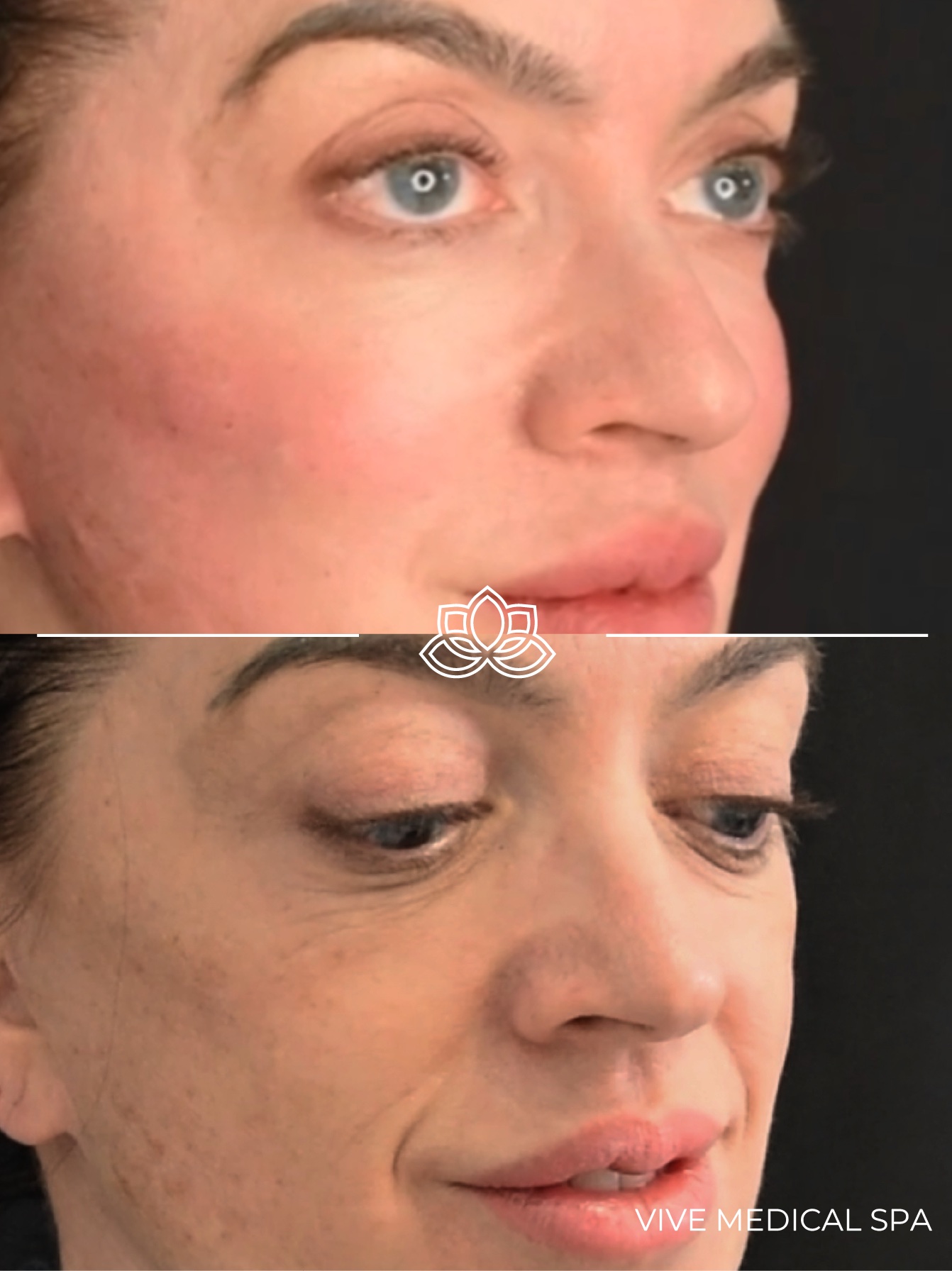Cheek filler treatment at Vive Med Spa