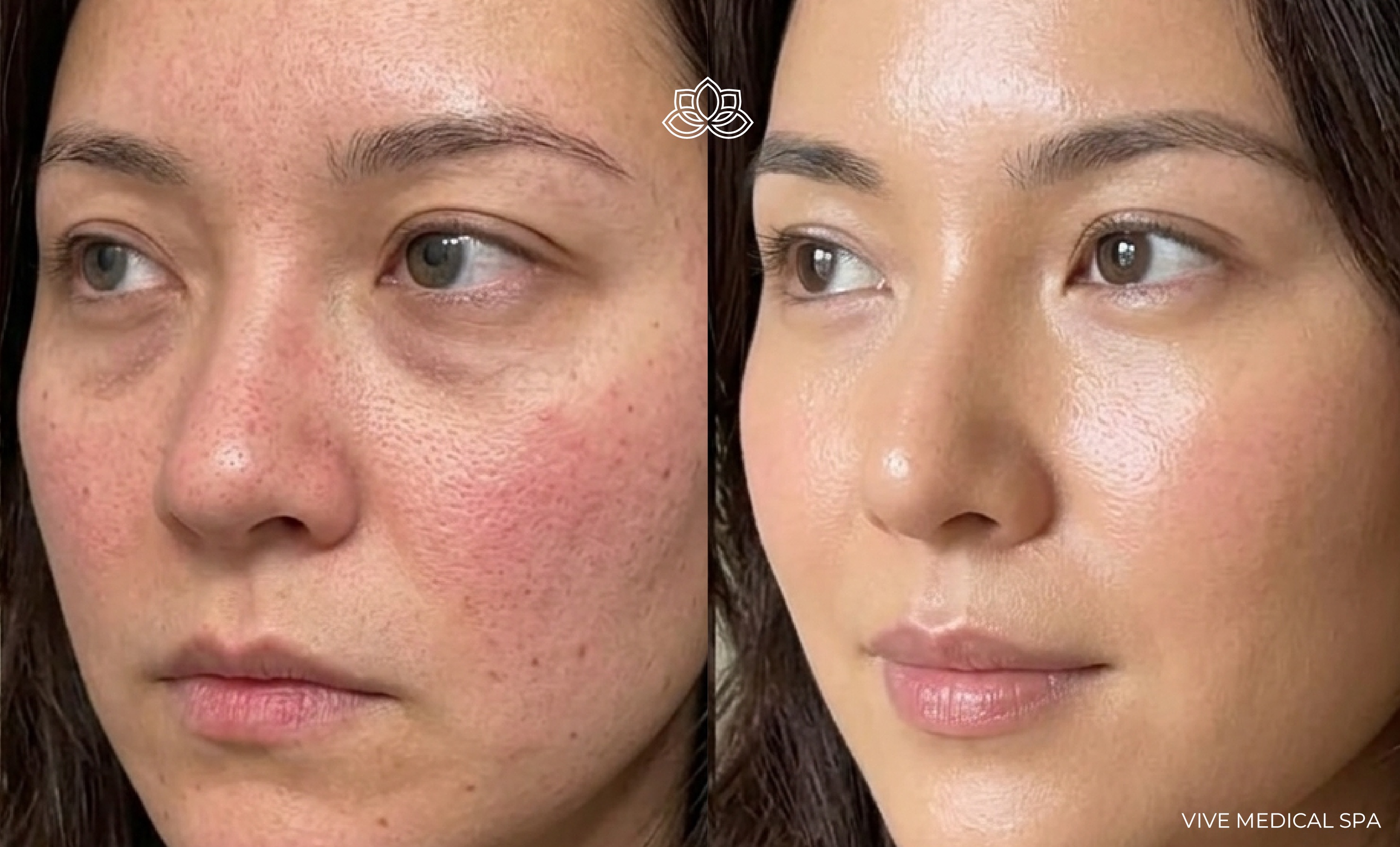 Cheek fillers procedure at Vive Med Spa Tijuana