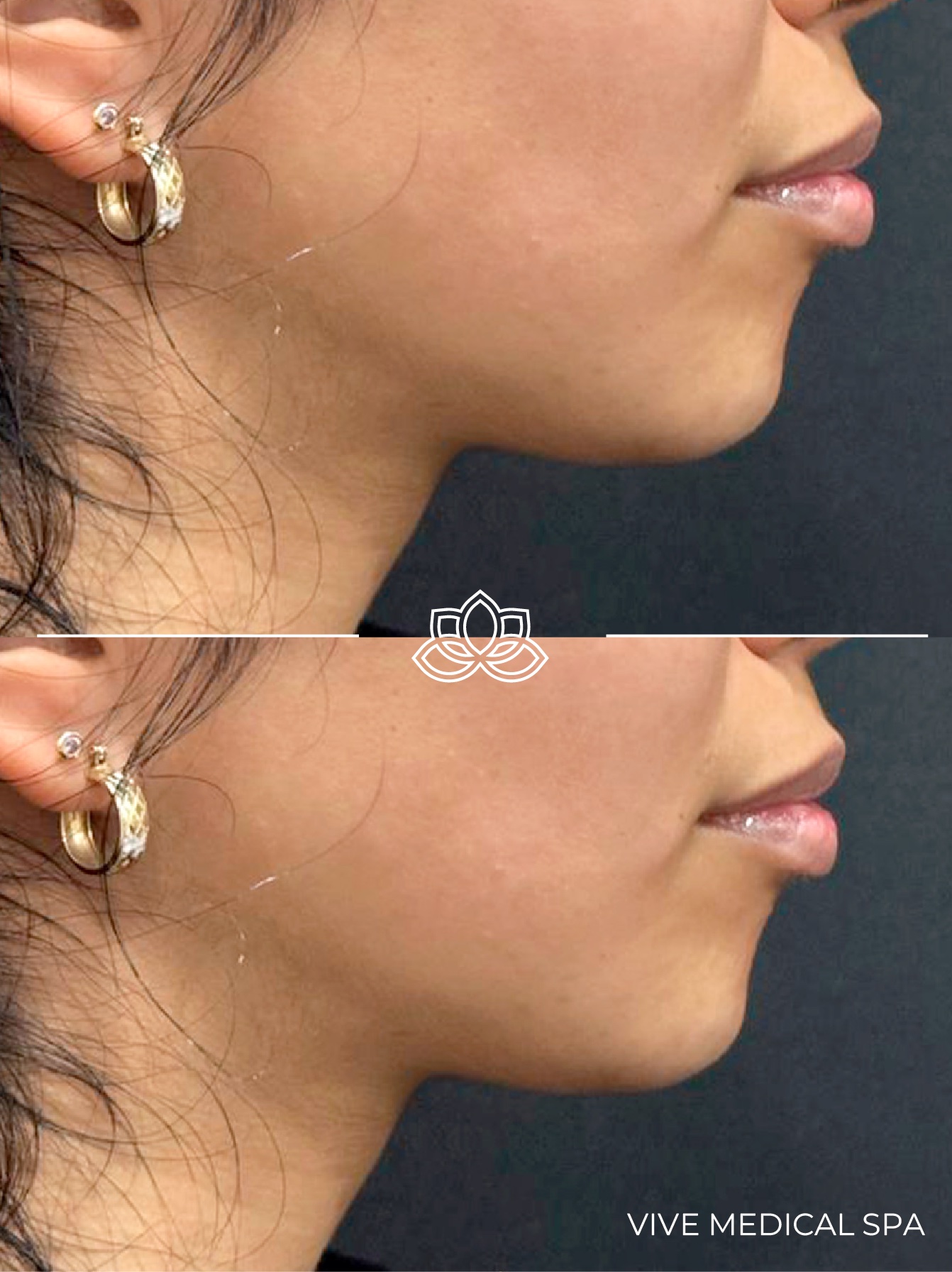 Chin filler treatment at Vive Med Spa Tijuana