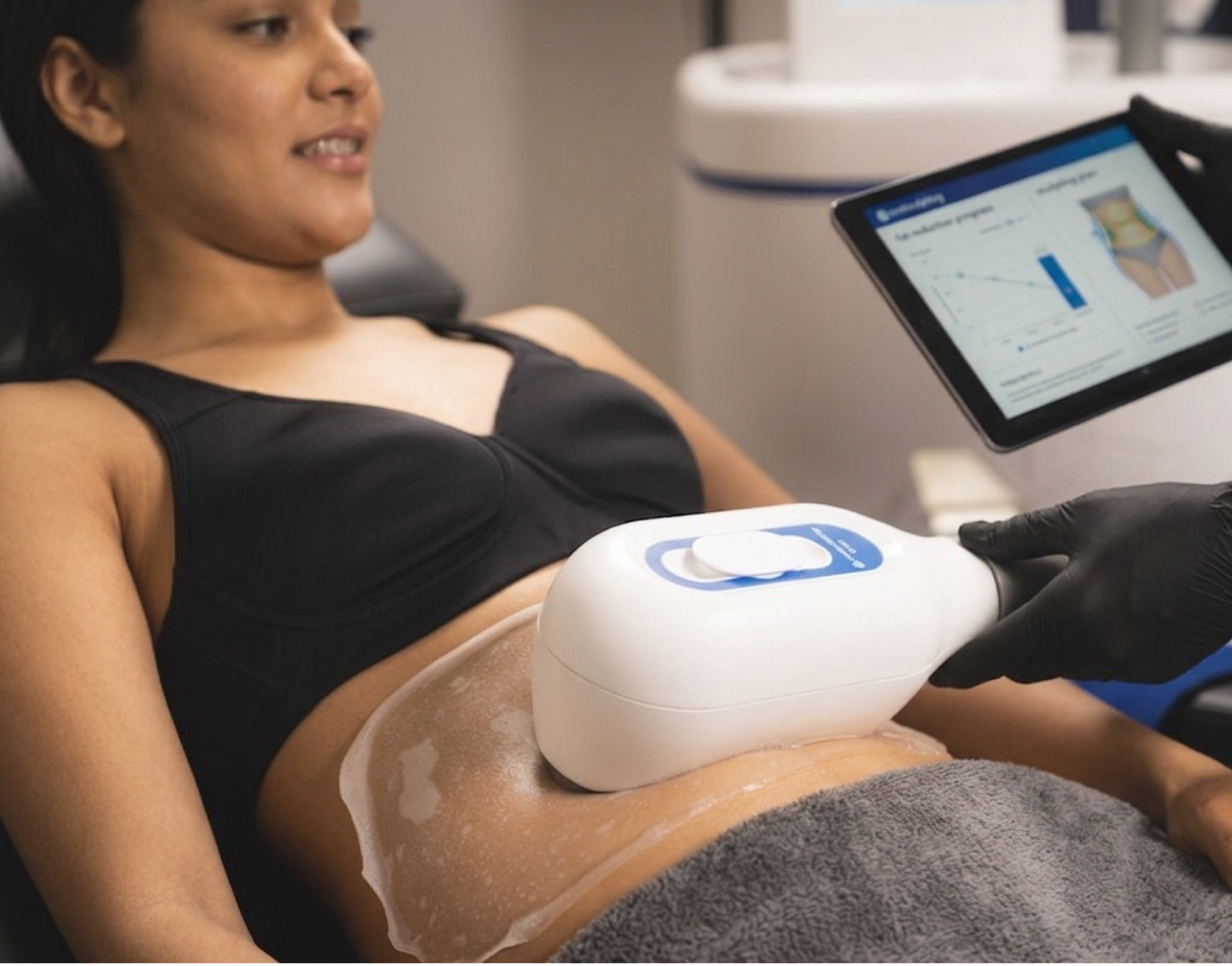 CoolSculpting results at Vive Medical Spa
