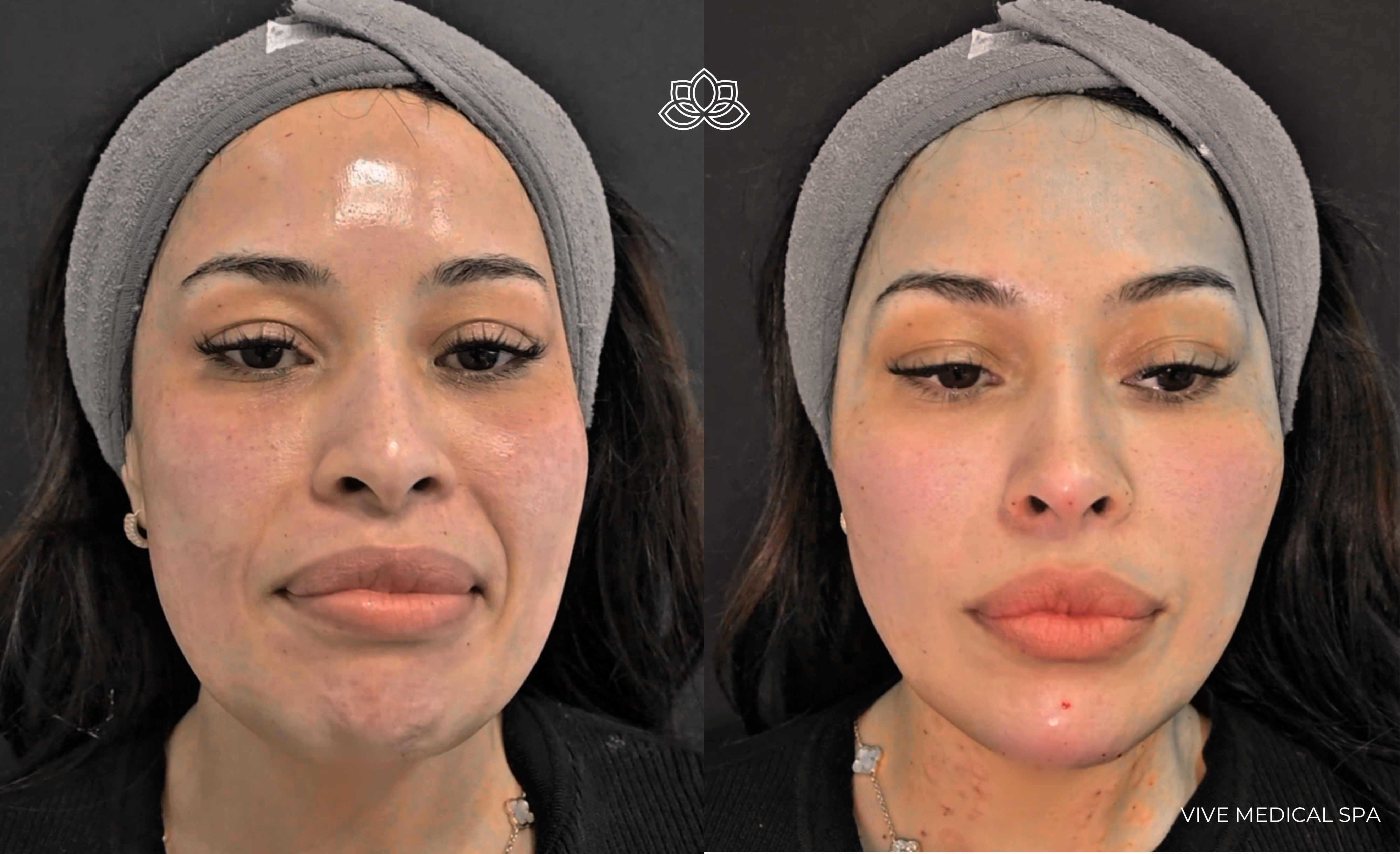 Endymed 3DEEP radiofrequency clinical image at Vive Medical Spa