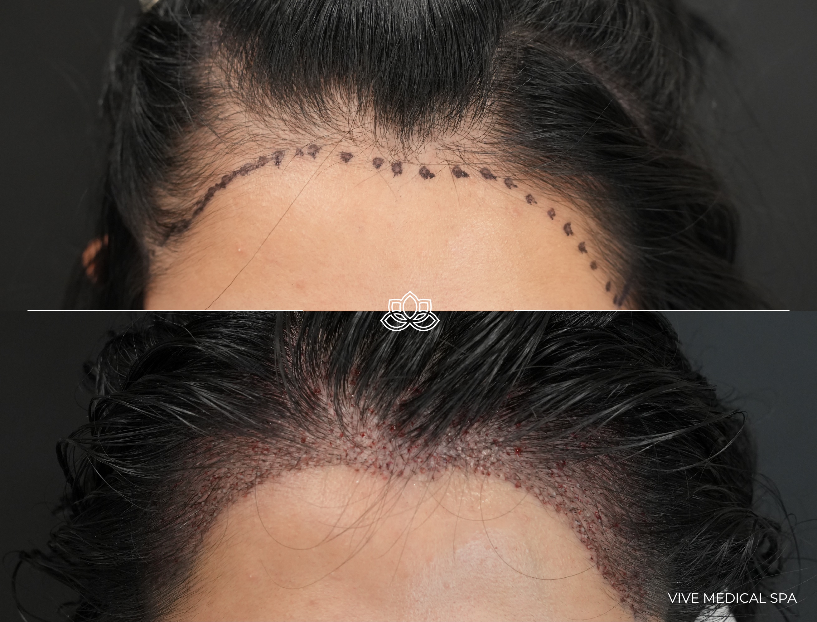 FUE Hair Transplant in Tijuana - Natural-looking results at Vive Med Spa