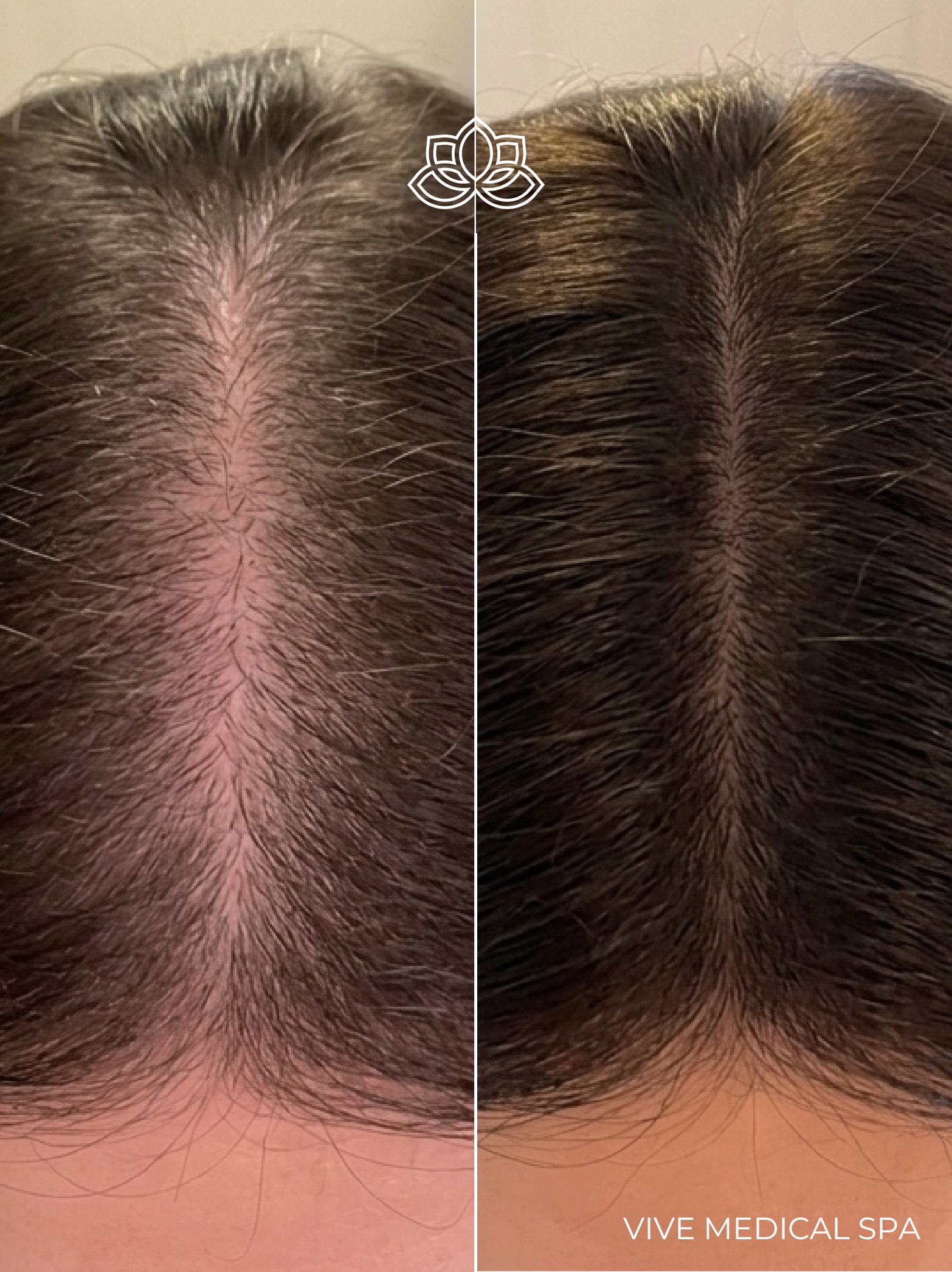Hair Mesotherapy treatment in Tijuana - Non-surgical hair restoration at Vive Med Spa