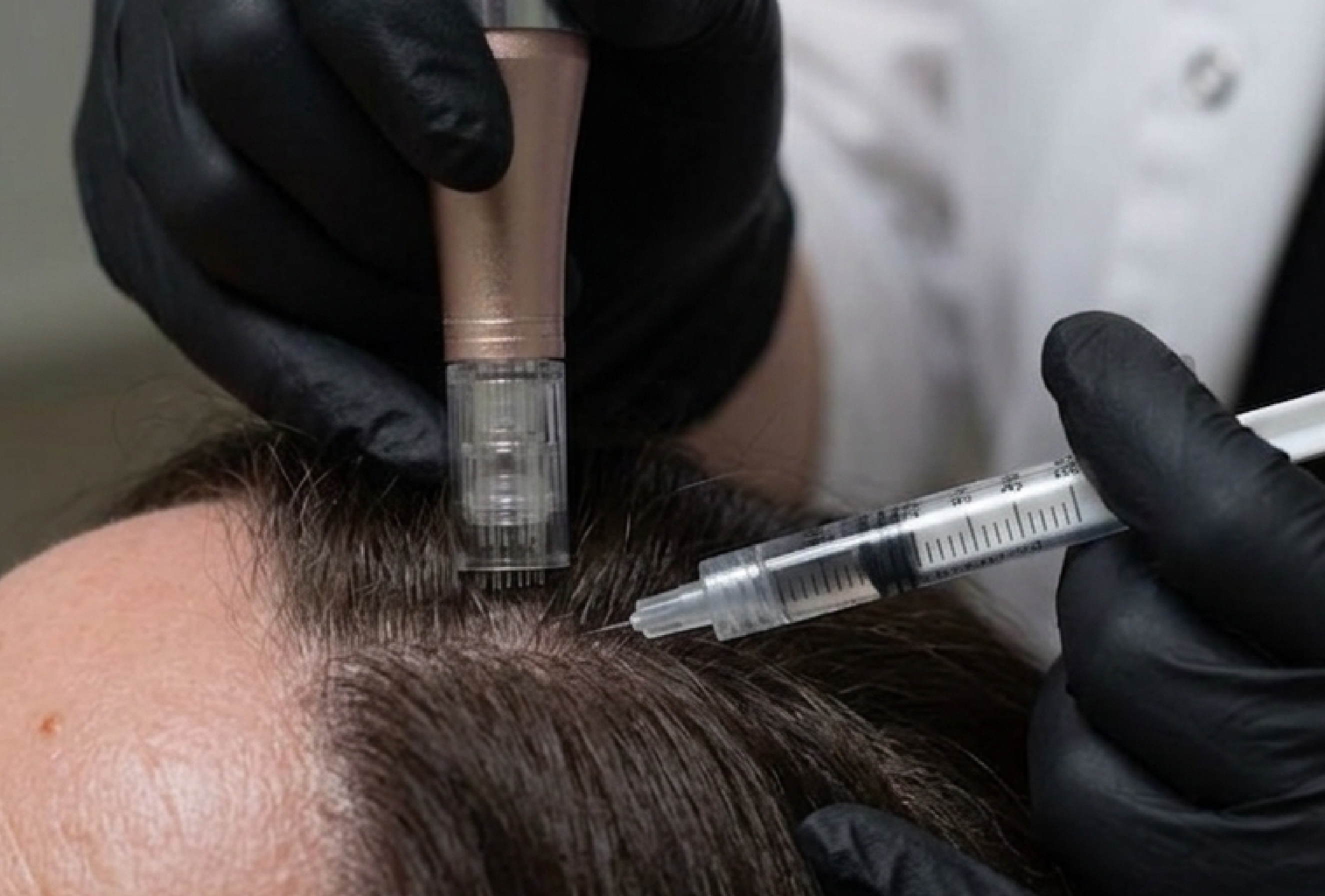 Hair mesotherapy consultation at Vive Med Spa