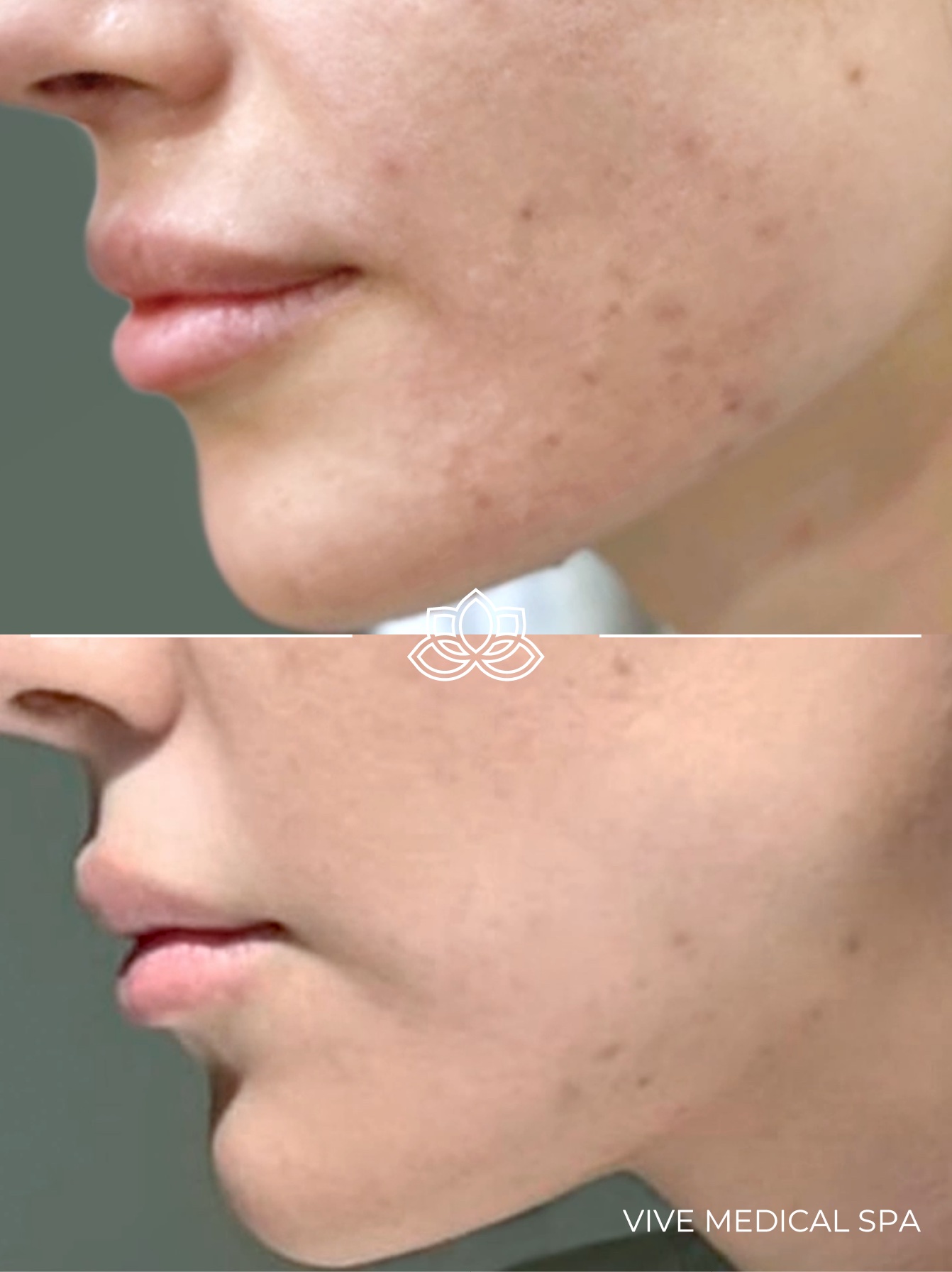 Kybella treatment at Vive Medical Spa - double chin reduction