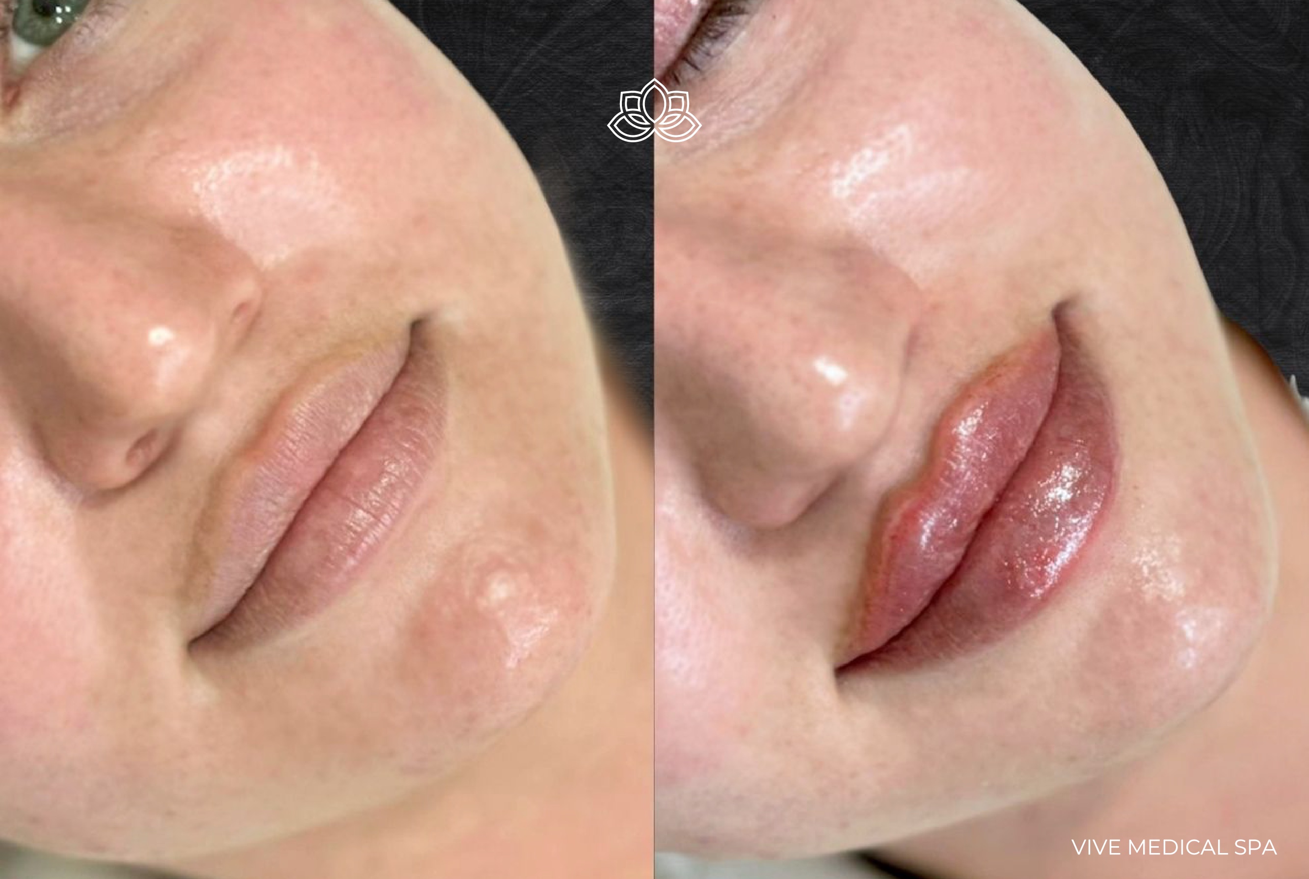 Lip filler results - Dr. Jorge - Vive Medical Spa