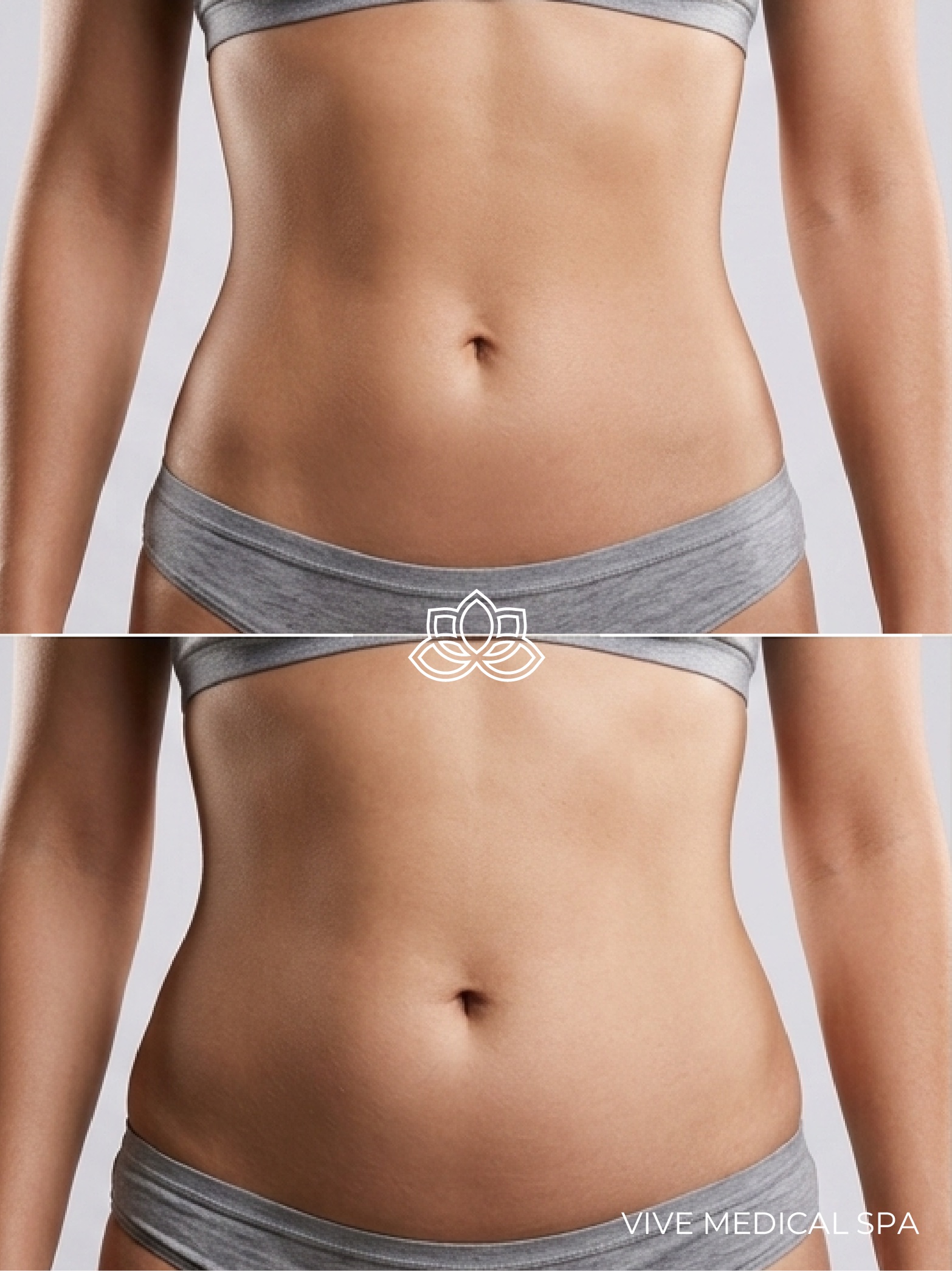 Liposonix treatment - HIFU body contouring at Vive Med Spa