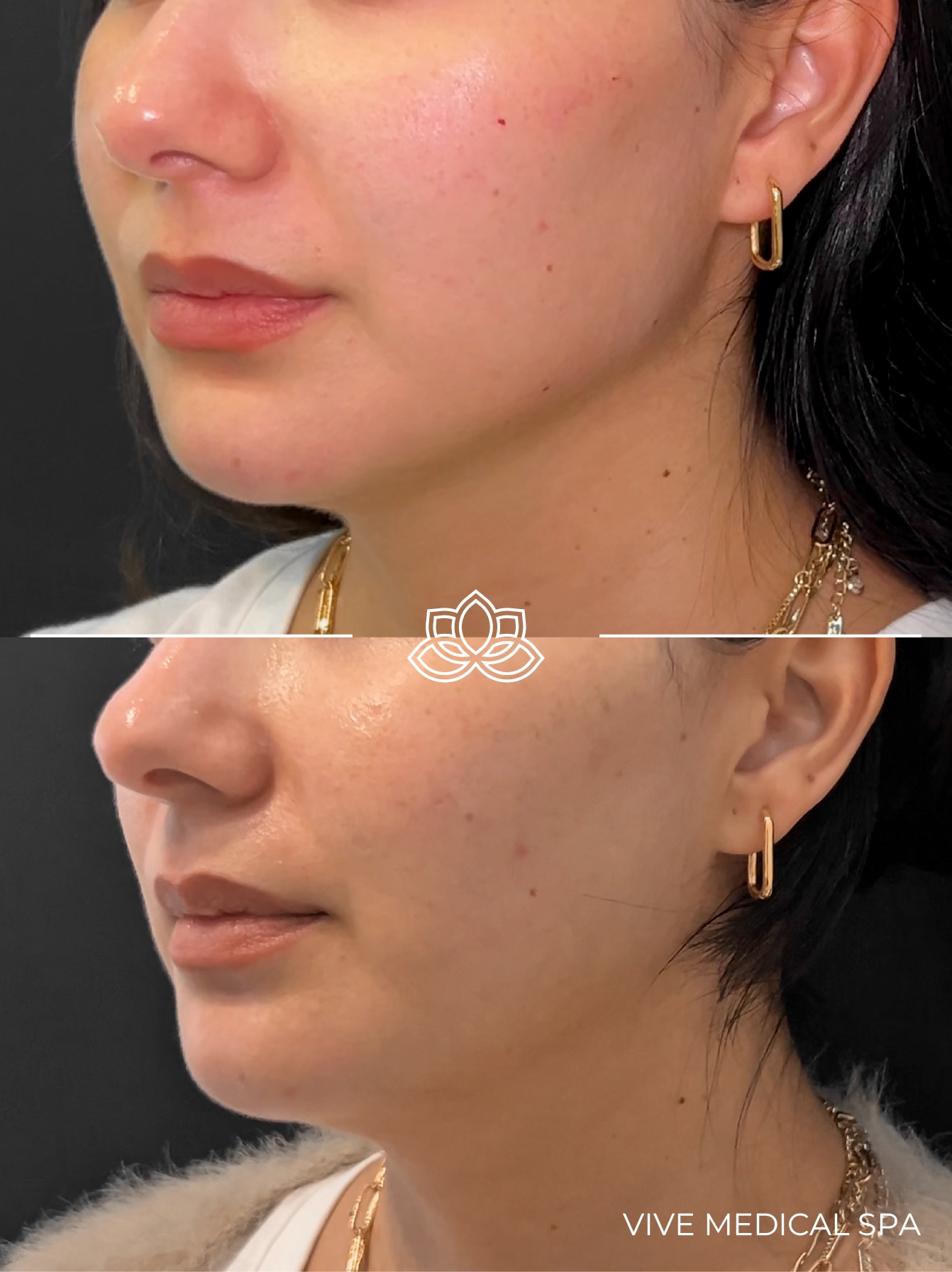 Men's jaw contouring results - Vive Medical Spa Tijuana