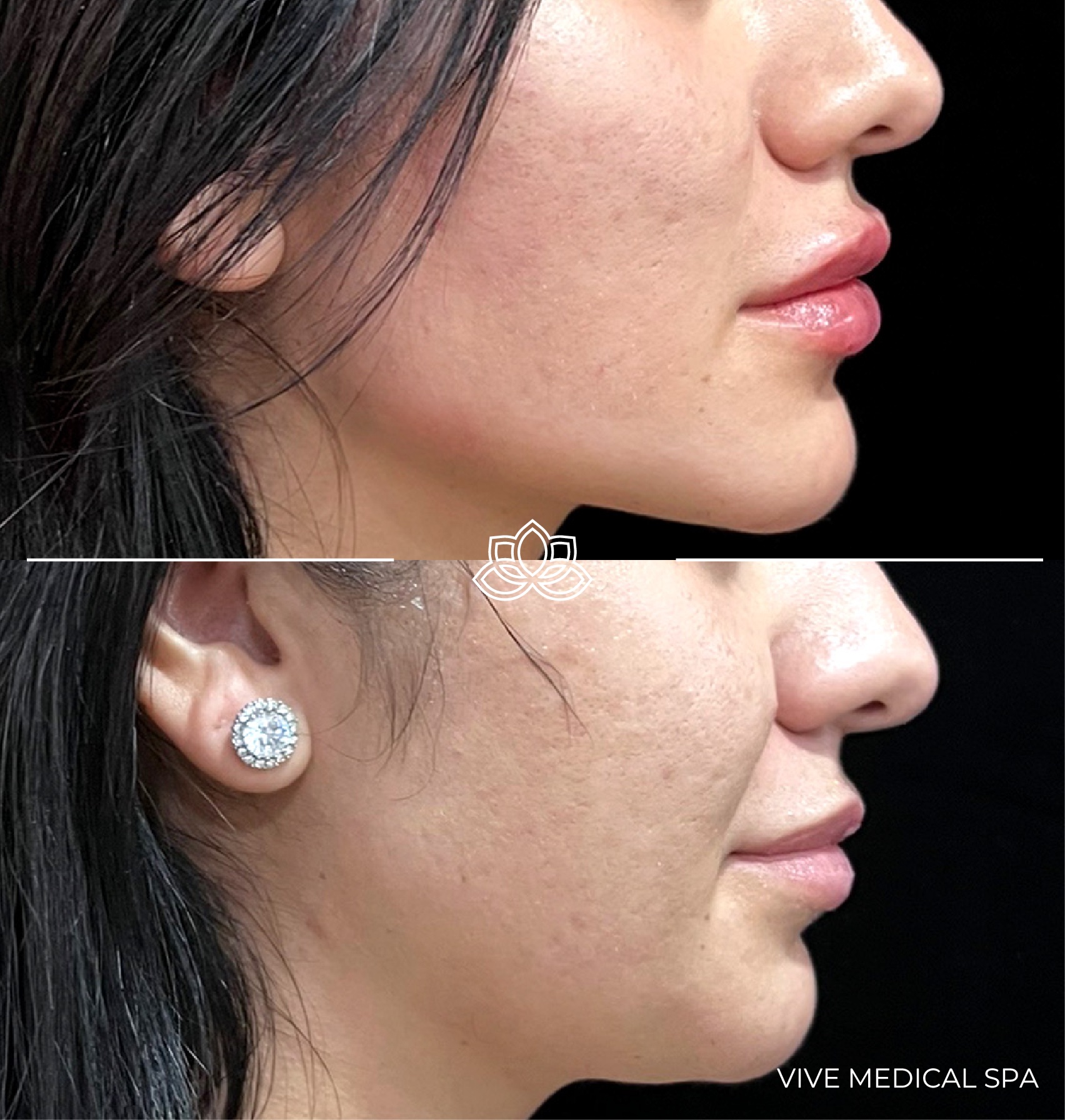 Men's jaw filler results - Vive Medical Spa