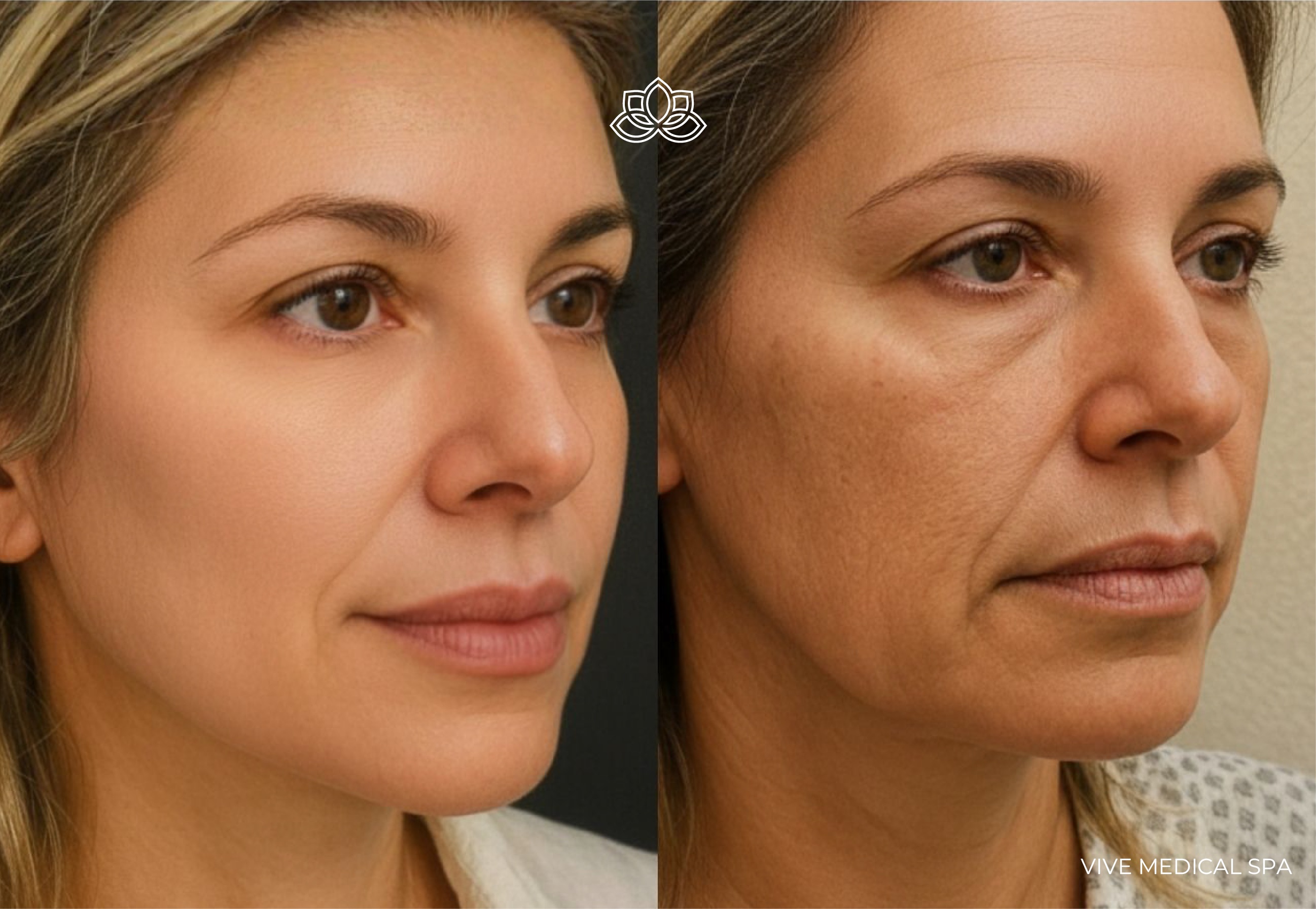 Morpheus8 results at Vive Medical Spa Tijuana