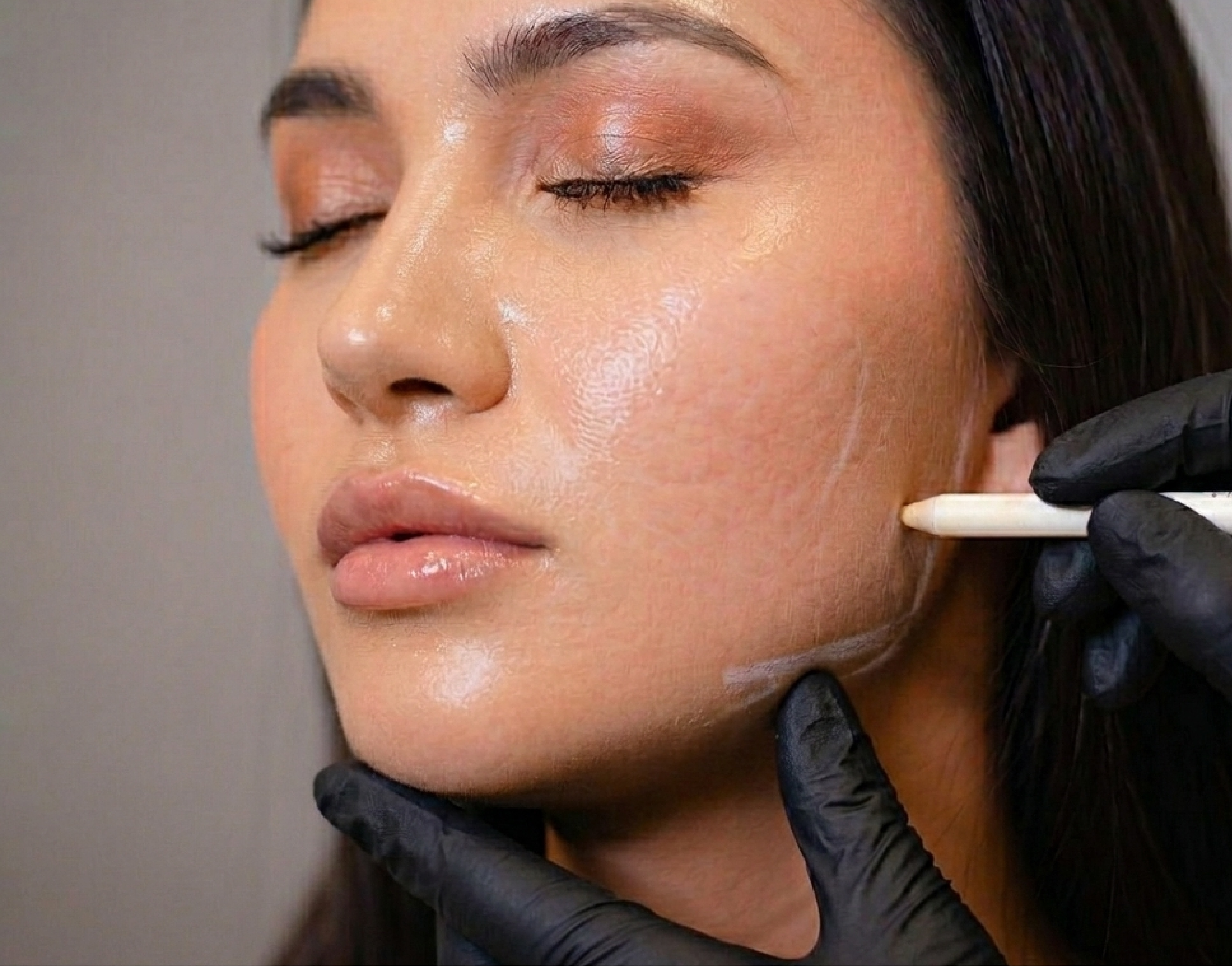 Radiesse treatment in Tijuana, Mexico - Advanced collagen biostimulation at Vive Med Spa
