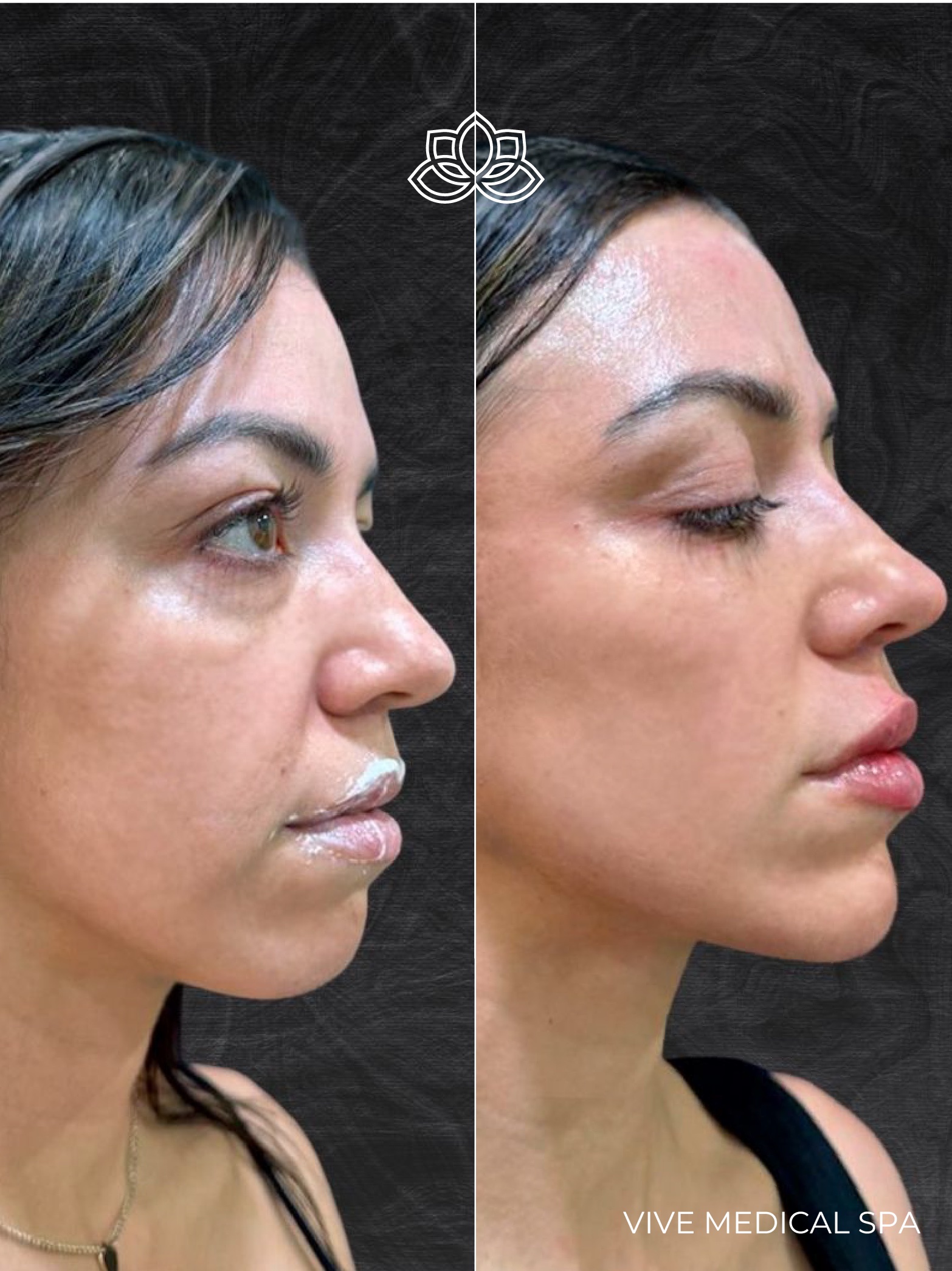 Sculptra injectable treatment - poly-L-lactic acid collagen stimulation