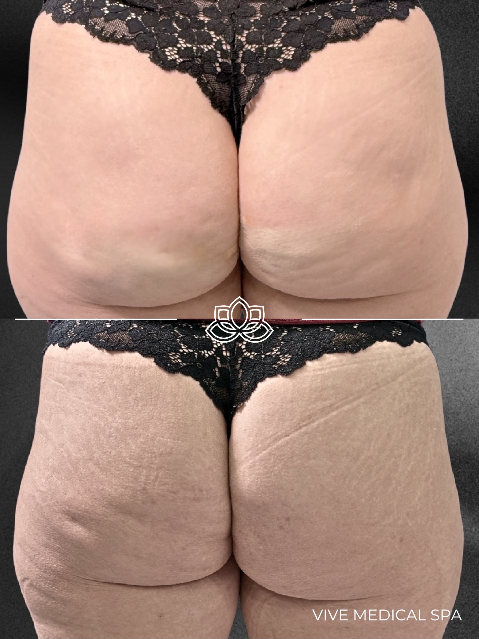 Zionic body remodeling clinical banner from Termosalud at Vive Medical Spa