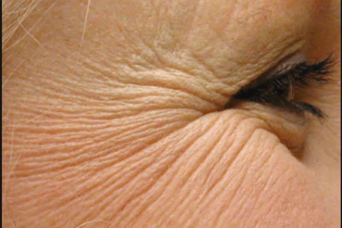 womans profile view of crows feet wrinkles