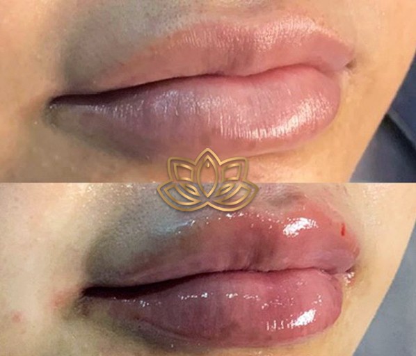 Lips filling in tijuana