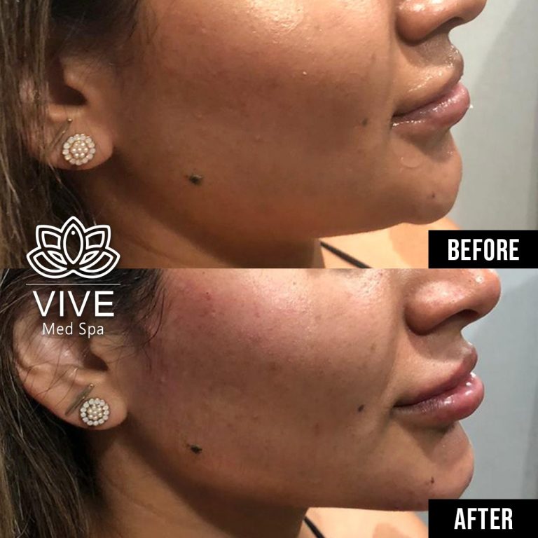 Before & Afters Tijuana VIVE Medical Spa