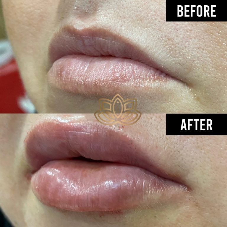 Before & Afters Tijuana VIVE Medical Spa