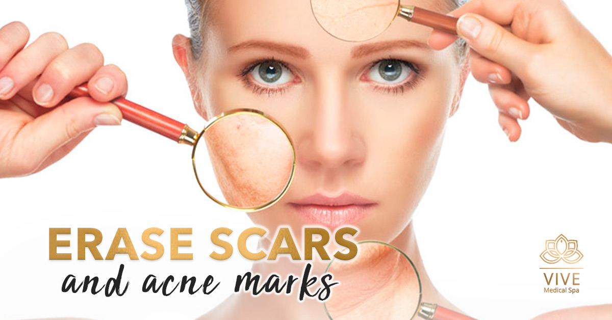 Erase-scars-and-acne-marks
