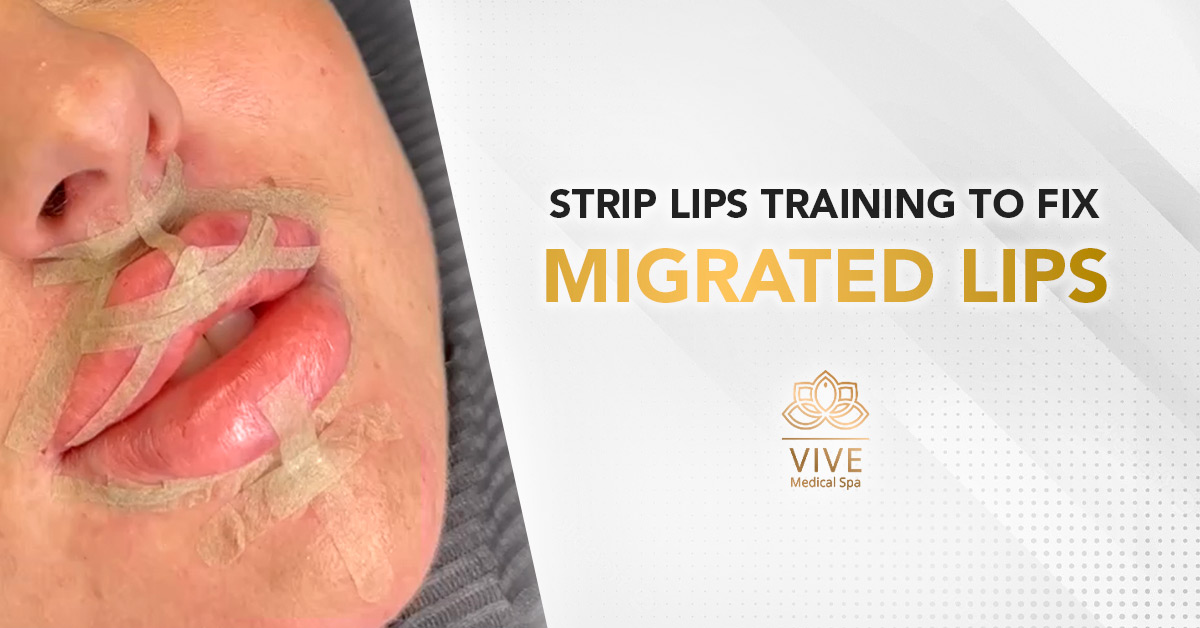 Close-up of lip filler correction using Strip Lips technique to fix migrated filler — Vive Medical Spa Tijuana