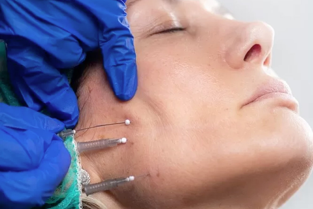 Close-up of PDO thread lift treatment for facial rejuvenation in Tijuana