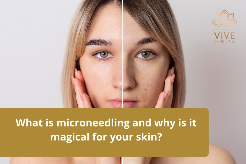 Microneedling Before and After | Skin Transformation at VIVE Medical Spa