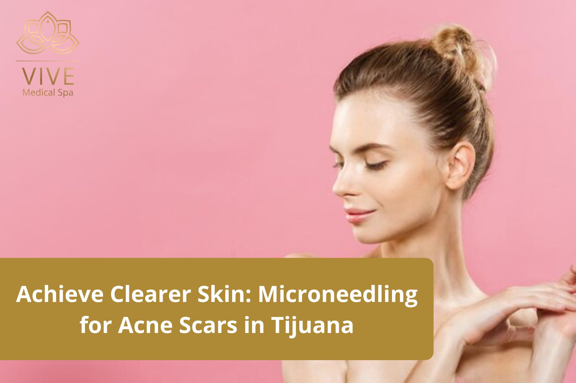 Achieve Clearer Skin Microneedling for Acne Scars in Tijuana