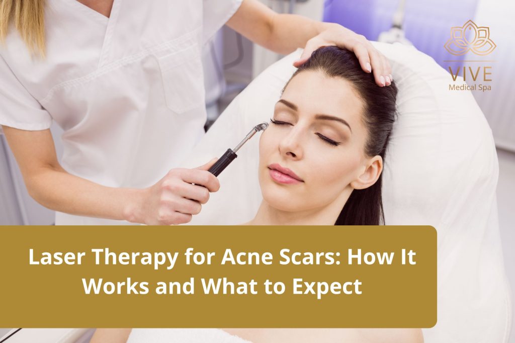 Woman receiving laser therapy for acne scars at VIVE Medical Spa in Tijuana.