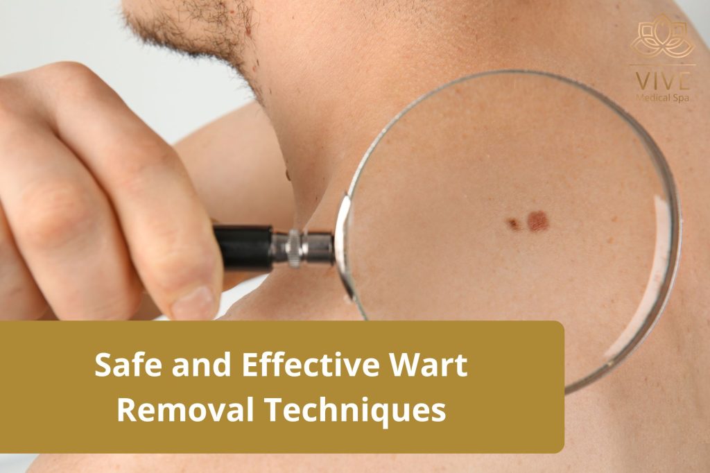Wart removal in Tijuana – Professional dermatological treatments at Vive Medical Spa for safe, effective, and scar-free wart removal.