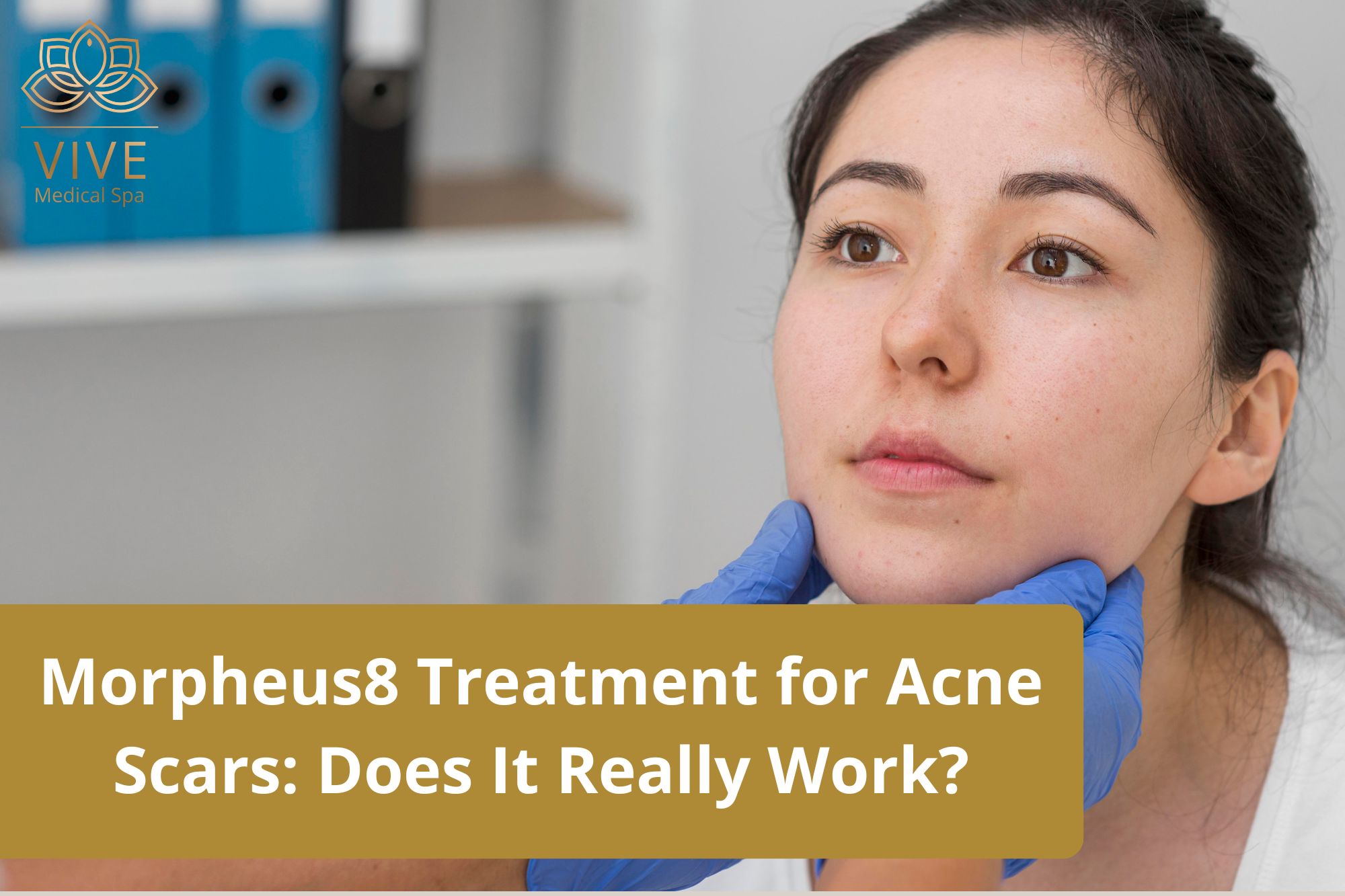 Morpheus8 for acne scars in Tijuana – RF microneedling treatment at Vive Medical Spa for skin rejuvenation and scar reduction.