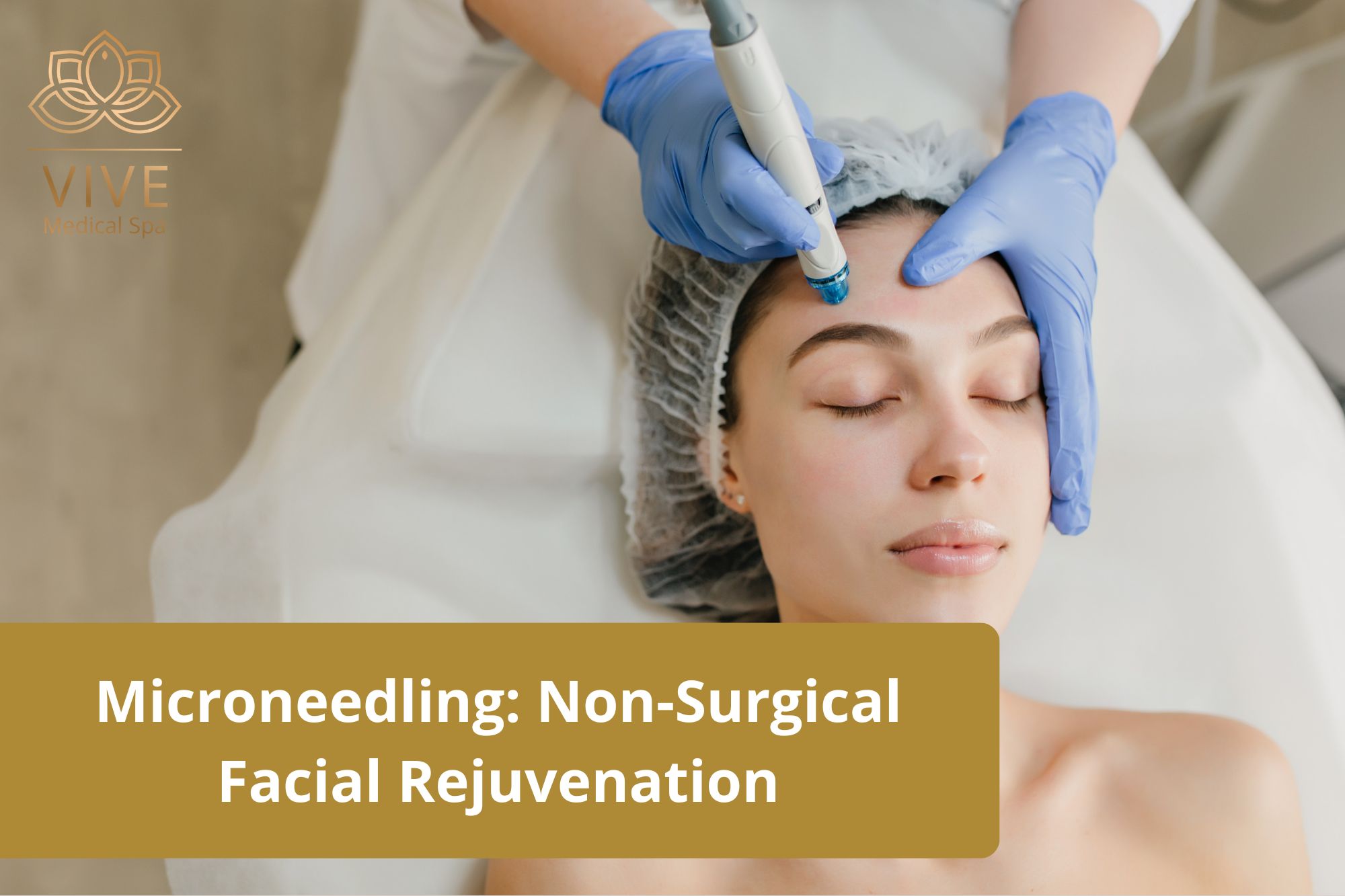 Microneedling in Tijuana at Vive Medical Spa – Non-surgical facial rejuvenation procedure for smooth and youthful skin.