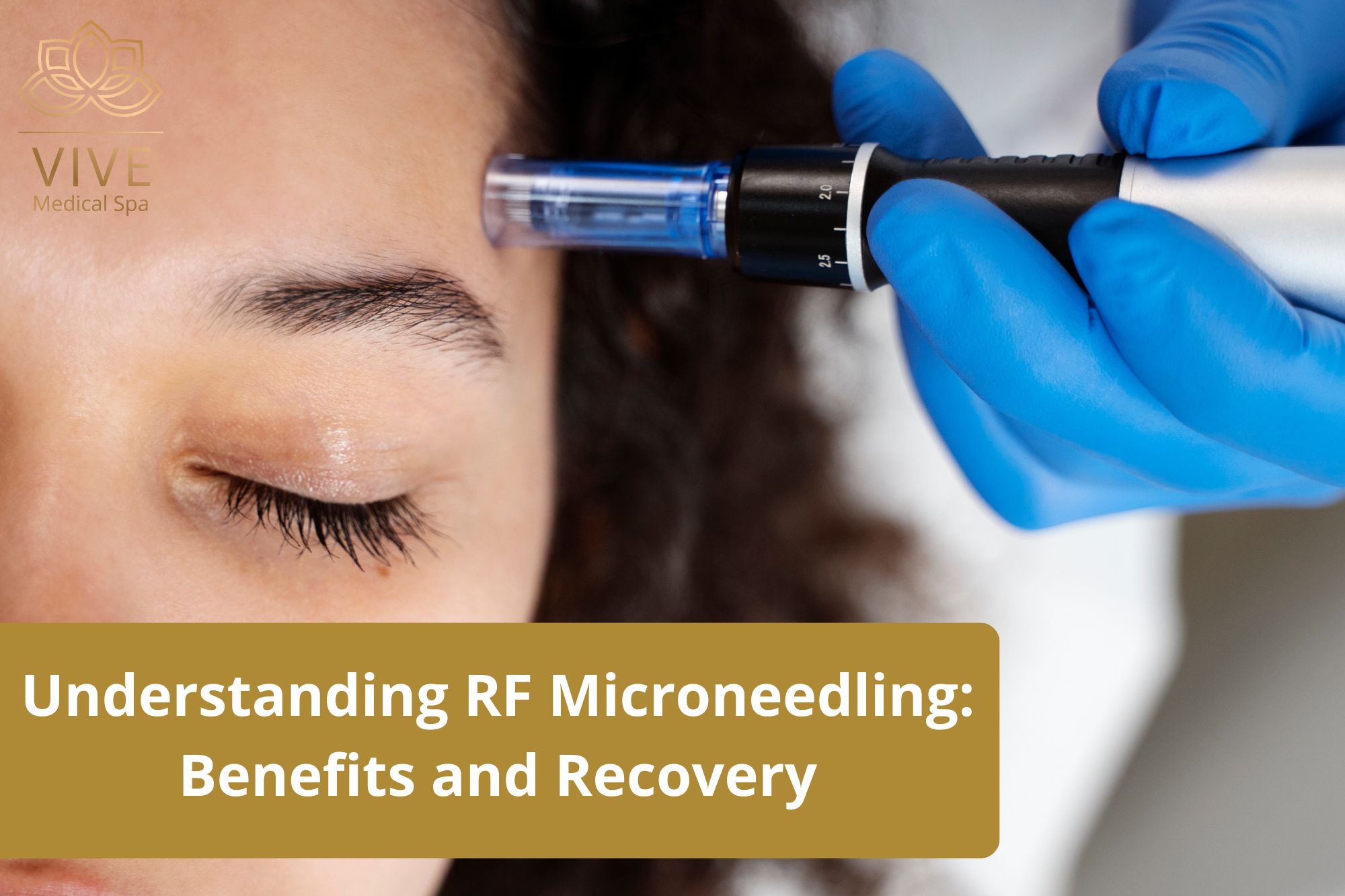 Close-up of RF Microneedling treatment on a patient’s forehead at Vive Medical Spa, emphasizing skin rejuvenation and recovery.