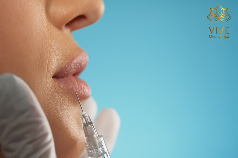Stock image of lip filler injection at VIVE Medical Spa Tijuana