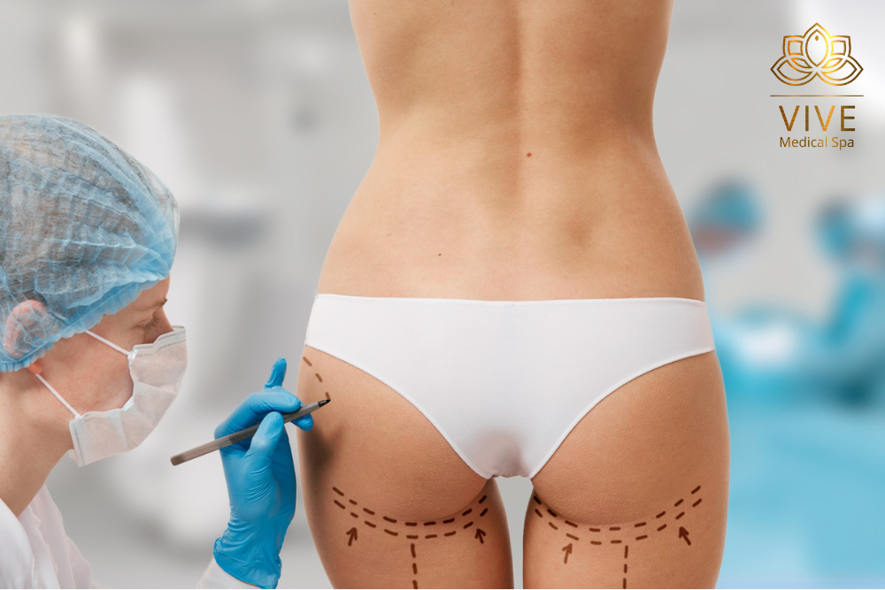 Stock image of Brazilian Butt Lift (BBL) surgery markings at VIVE Medical Spa Tijuana