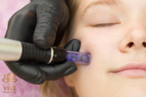 Stock image of microneedling facial treatment at VIVE Medical Spa Tijuana